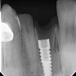 CLAVES PARA IDENTIFICAR UN IMPLANTE – ES