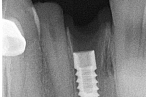 radiografia-periapical