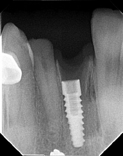radiografia-periapical